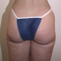 Liposuccion après