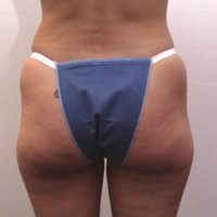 Liposuccion avant