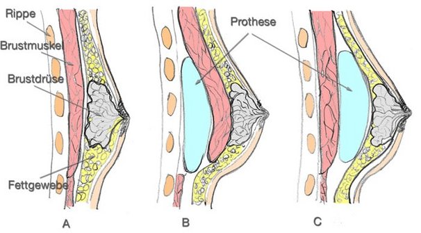 Brustprothese