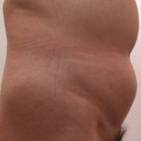 Belly Liposuction before
