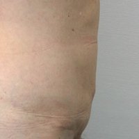 Bauchdeckenstraffung nachher