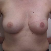Breast reconstruction after