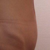 Belly Liposuction after