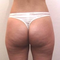 Liposuccion avant