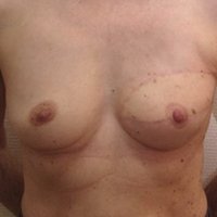 Breast reconstruction after