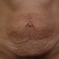 Bauchdeckenstraffung vorher