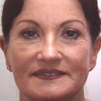 Eyelid surgery after