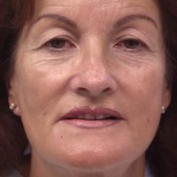 Eyelid surgery before